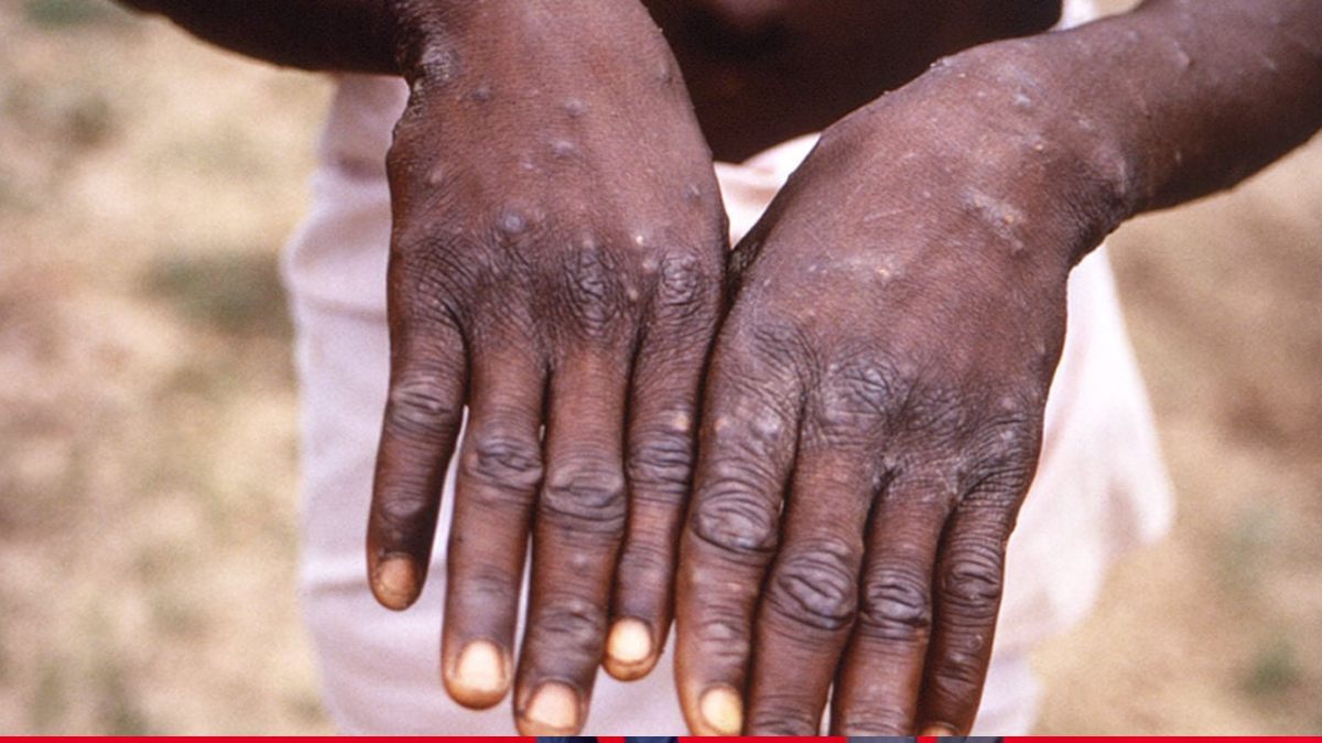 Ministry of Health reports a second case of Mpox in Kenya
