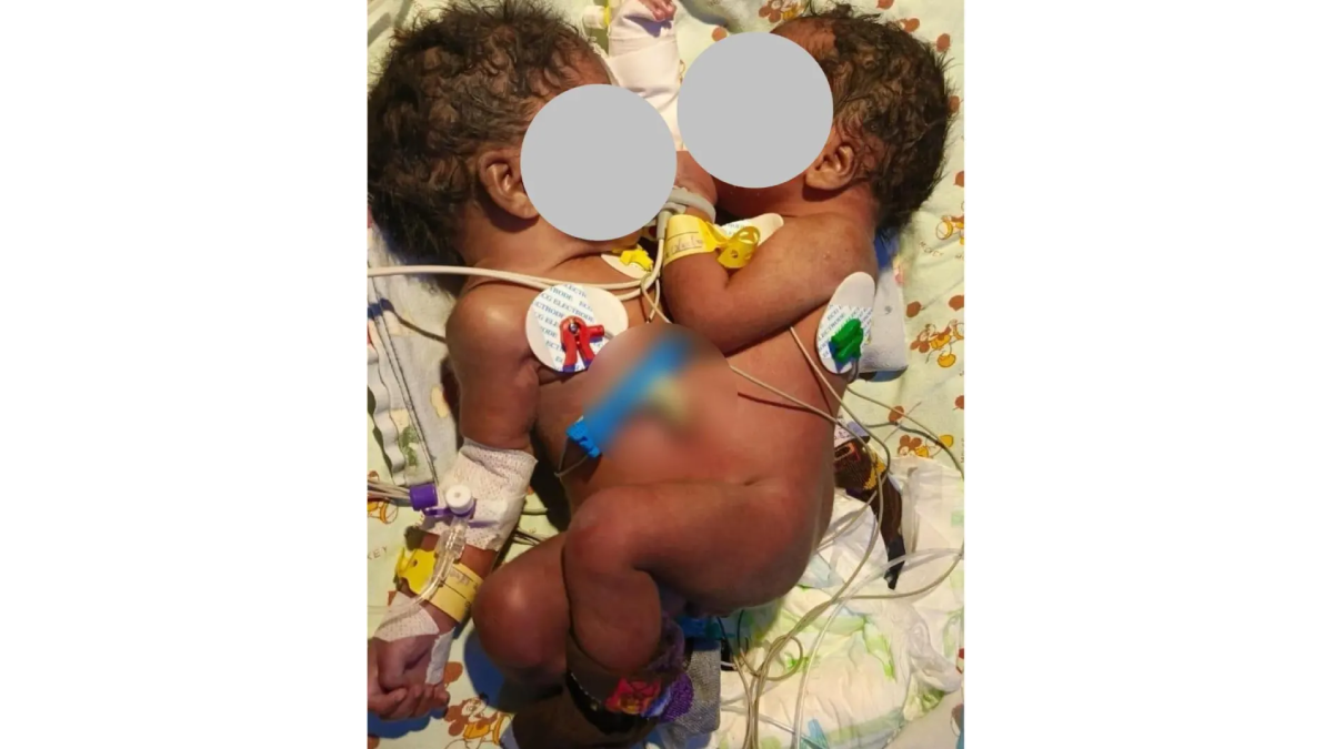 KNH issues update on status of conjoined twins under specialised care