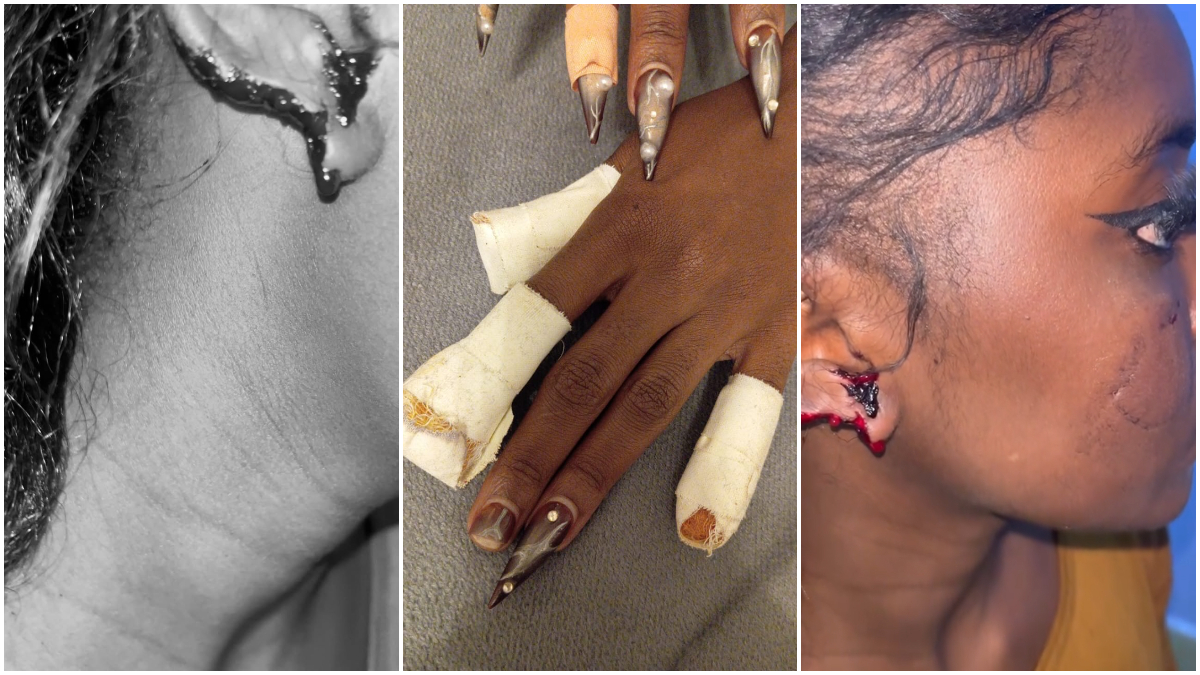 Bleeding ear lobe, bite marks on the cheek: Assault of Instagram Influencer Jazba Jayce sparks fresh calls to #EndFemicide