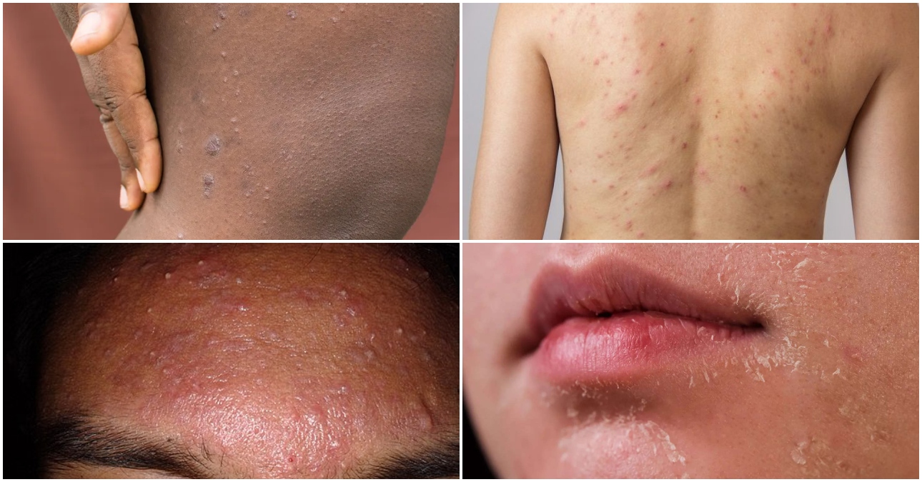 Why skin conditions are becoming more common in Kenya