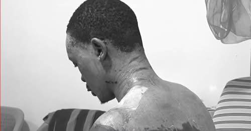 Multimedia University student seeks justice after assault by girlfriend left him with severe burns