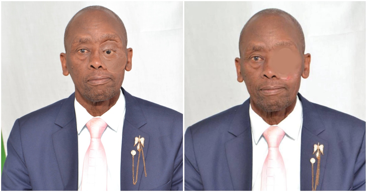 Second chance at facing the World: KNH records Kenya’s first orbital–facial prosthesis in a public hospital