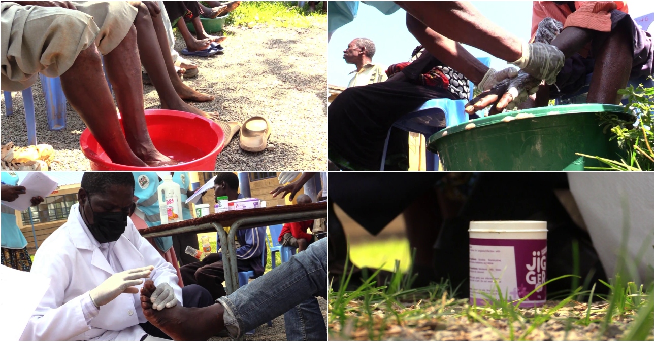 Pain-free Jigger treatment developed by MMUST researchers to end years of stigma and restores health and livelihoods in western Kenya